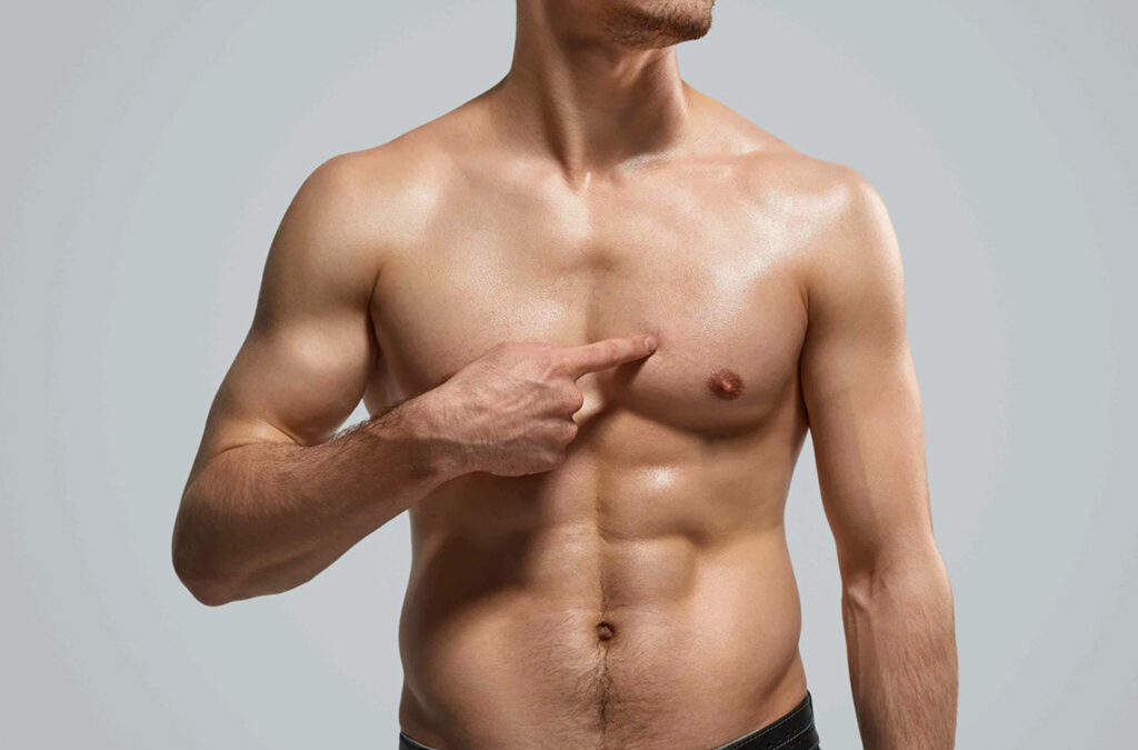 Ginecomastia: Causas, Prevención y Tratamiento