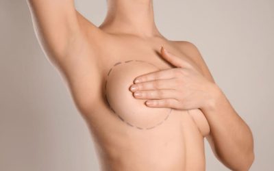 Mastopexia o la técnica quirúrgica con la que lograrás recuperar el pecho tras la lactancia
