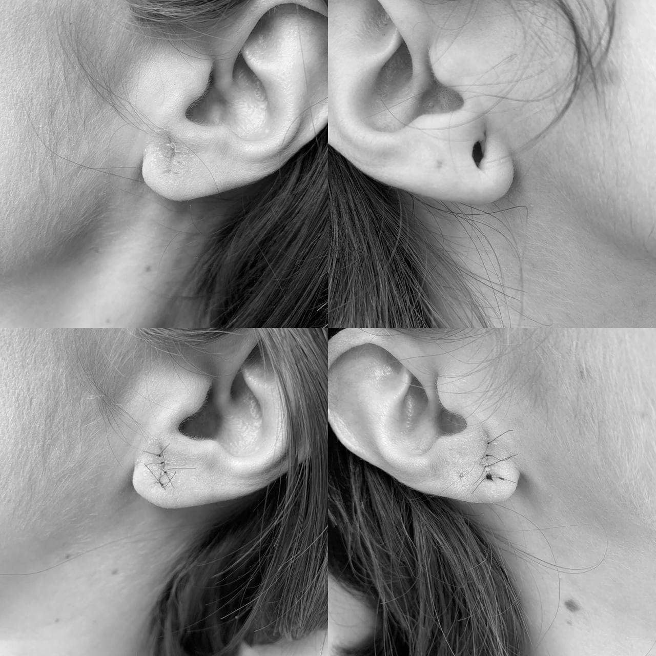 Otoplastia caso2