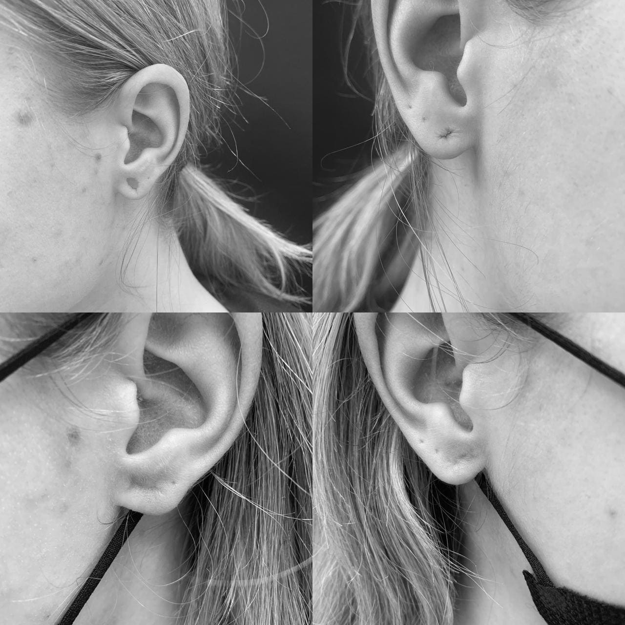 Otoplastia caso1