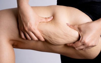 ¿La grasa vuelve después de una liposucción?