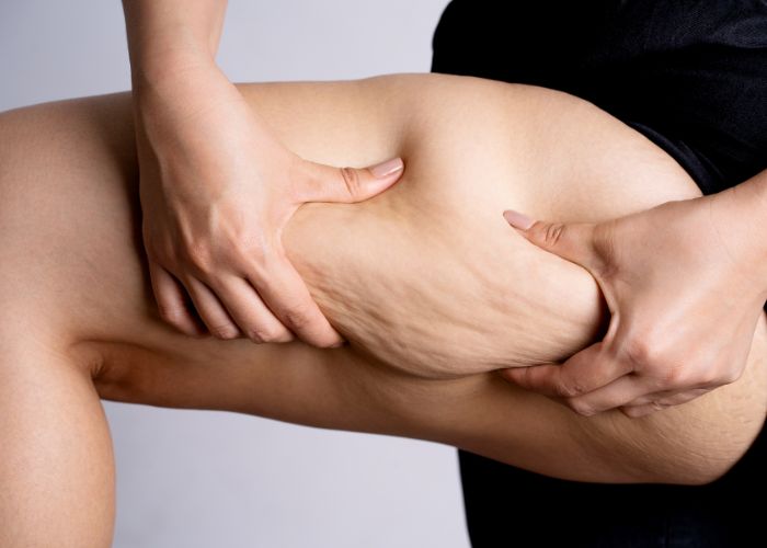 ¿La grasa vuelve después de una liposucción?