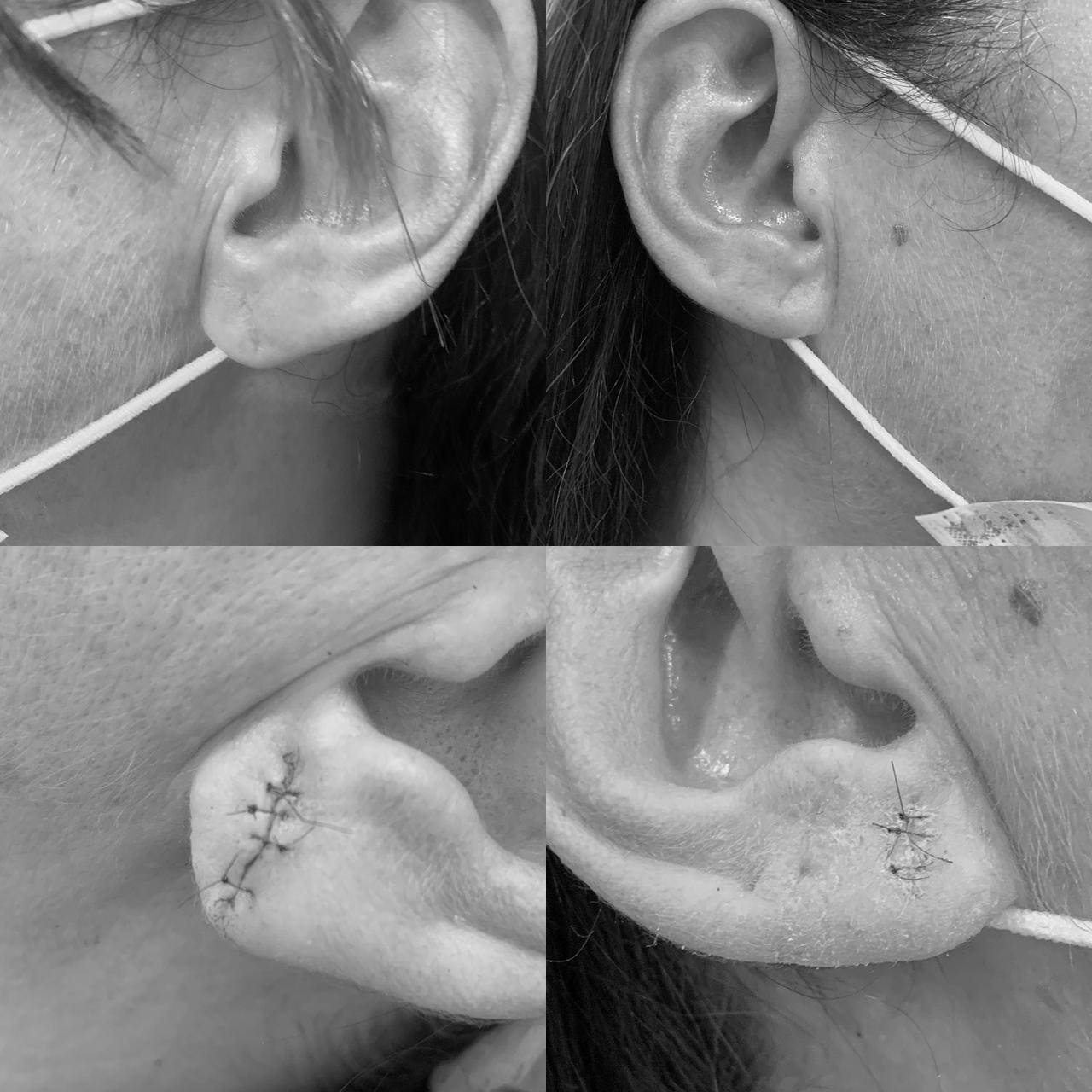 Otoplastia caso1