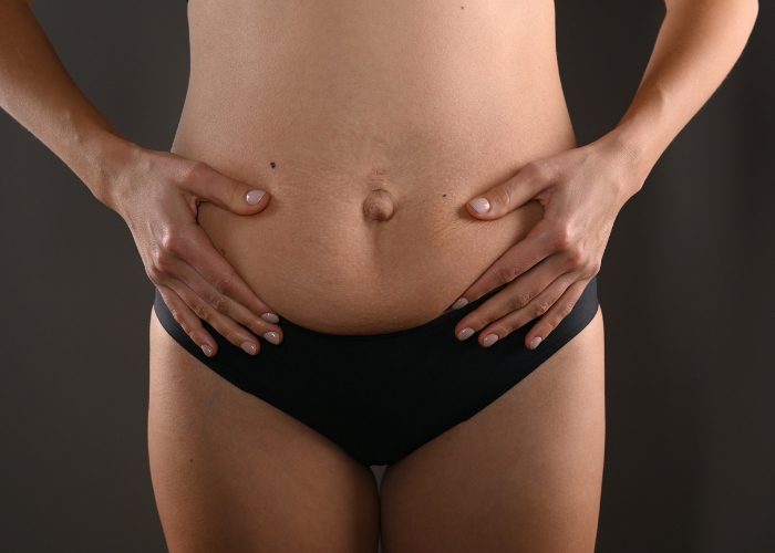 Síntomas de la diástasis abdominal y cuándo recurrir a cirugía en Madrid