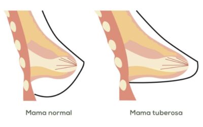 Pecho tubular: qué es, cómo se aborda y qué resultados esperar
