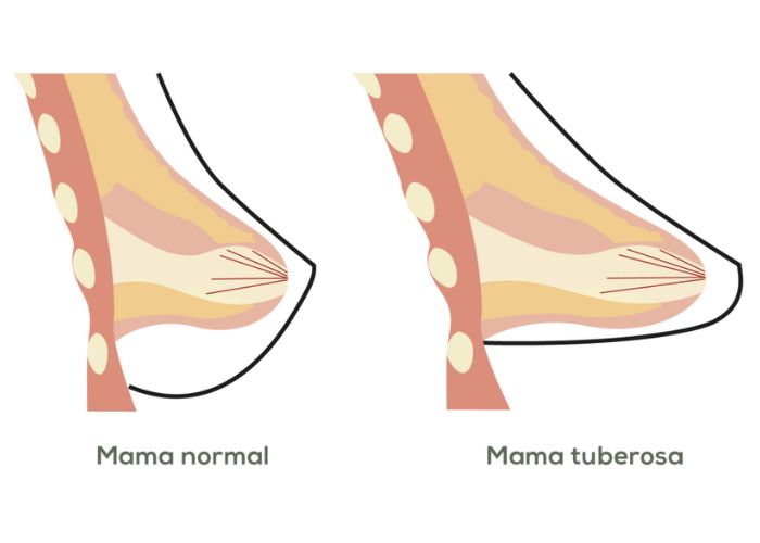 pecho tubular pecho tubular