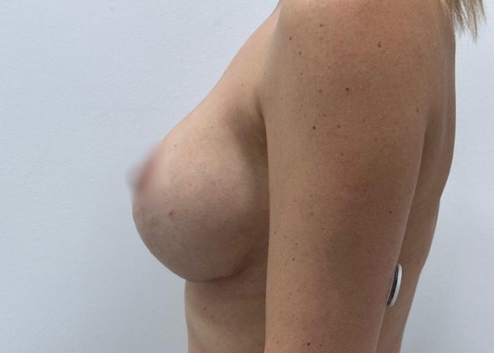 Mastopexia con prótesis