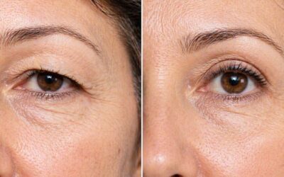 Blefaroplastia: cuándo está recomendada y qué puedes esperar de esta cirugía