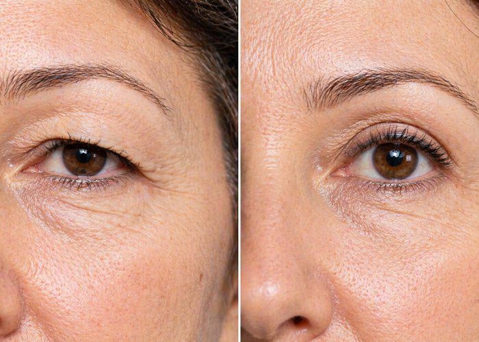 blefaroplastia